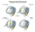 Arthroscopic Partial Meniscectomy Royalty Free Stock Photo