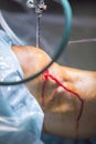 Arthroscopy orthopedic surgery knee arthroscope probe