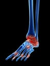 Arthrosis in the foot