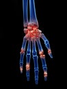 Arthrosis in the hand Royalty Free Stock Photo