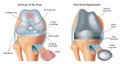 Arthrosis medical illustration 