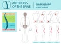 Arthrosis of Spine. Vector Illustration. Royalty Free Stock Photo