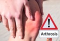 Arthrosis warning sign health shield