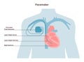 Artificial cardiac pacemaker anatomical scheme. Medical device