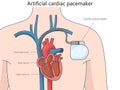 Artificial cardiac pacemaker medical device