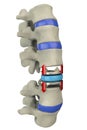 Artificial disc replacement, spine Surgical operation