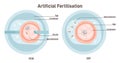 Artificial fertilization types. Female egg insemination by sperm with IVF