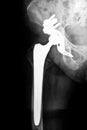 Artificial hip joint Royalty Free Stock Photo
