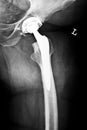 Artificial hip joint Royalty Free Stock Photo