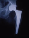 Artificial hip joint in the human thigh Royalty Free Stock Photo