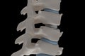 Artificial intervertebral disc prosthesis is installed between t