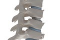 Artificial intervertebral disc prosthesis is installed between t