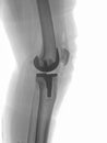 Artificial knee joint Royalty Free Stock Photo