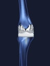 Artificial knee prosthesis or knee joint in blue shades