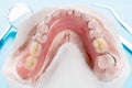 Artificial removable partial denture.