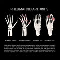 ARTHRITIS HAND LEG Rheumatoid Medicine Education Vector Scheme