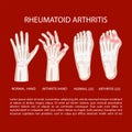 ARTRITIS LEG HAND Rheumatoid Medicine Education Vector Scheme