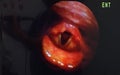 Arytenoids, vocal cords and epiglottis seen through laryngoscope