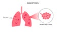 Asbestosis lung disease