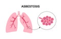 Asbestosis lung disease