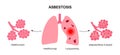 Asbestosis lung disease