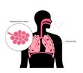 Asbestosis lung disease