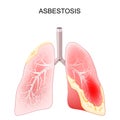 Asbestosis. Close-up of a cross section of human lungs with fibrosis and scarring Royalty Free Stock Photo