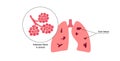 Asbestosis lung disease