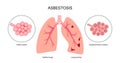 Asbestosis lung disease