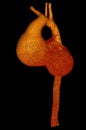 Ascending aortic aneurysm on computed tomography