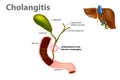 Ascending cholangitis, also known as acute cholangitis or simply cholangitis, is inflammation of the bile duct Royalty Free Stock Photo