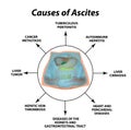 Ascites Free fluid in the abdominal cavity. Infographics. Vector illustration on isolated background.