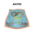 Ascites Free fluid in the abdominal cavity. Infographics. Vector illustration on isolated background.