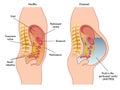 Ascites