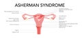 Asherman syndrome Female reproductive system scar tissue adhesions in uterus diagram with inscriptions. Front view