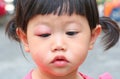 Asian baby girl eye swell Royalty Free Stock Photo