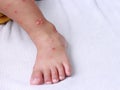 Asian boy foot blister virus hfmd infection rash skin