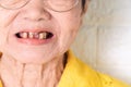 Asian Elderly woman over 70 years old be smile with a few broken teeth here have problem of ability to chew food of the elderly. H