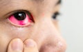 Asian lady woman with conjunctivitis is checking for her pink eye,girl with subconjunctival hemorrhage,bloodshot of the eyes, Royalty Free Stock Photo