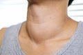 Asian lady woman patient have abnormal enlargement of thyroid gland Hyperthyroidism overactive thyroid Royalty Free Stock Photo