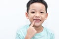 Asian little boy was pointing at his permanent teeth are growing. A 5-year-old boy whose upper milk tooth incisor fell out. Kid Royalty Free Stock Photo