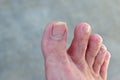 Asian man foot with dry skin, toenail fungus. Health Concept. Royalty Free Stock Photo