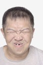 Asian man grimace with bad teeth