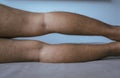 Asian man leg bandy-legged shape of legs