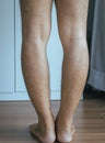 Asian man leg bandy-legged shape of the legs Royalty Free Stock Photo