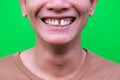 Asian man smiling showing his teeth unattractive on green background.