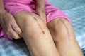 Asian senior or elderly old lady woman patient show her scars surgical total knee joint replacement Suture wound surgery Royalty Free Stock Photo