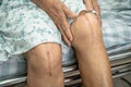 Asian senior or elderly old lady woman patient show her scars surgical total knee joint replacement Suture wound surgery Royalty Free Stock Photo