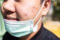 Asian teenager boy with acne on the face caused by wearing medical face mask,accumulation of bacteria from sweat,skin irritation, Royalty Free Stock Photo