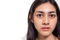 Asian woman gets freckles, blemish, pimple and dull skin on her face. Attractive beautiful Asia woman get eye dark circles, She ge Royalty Free Stock Photo